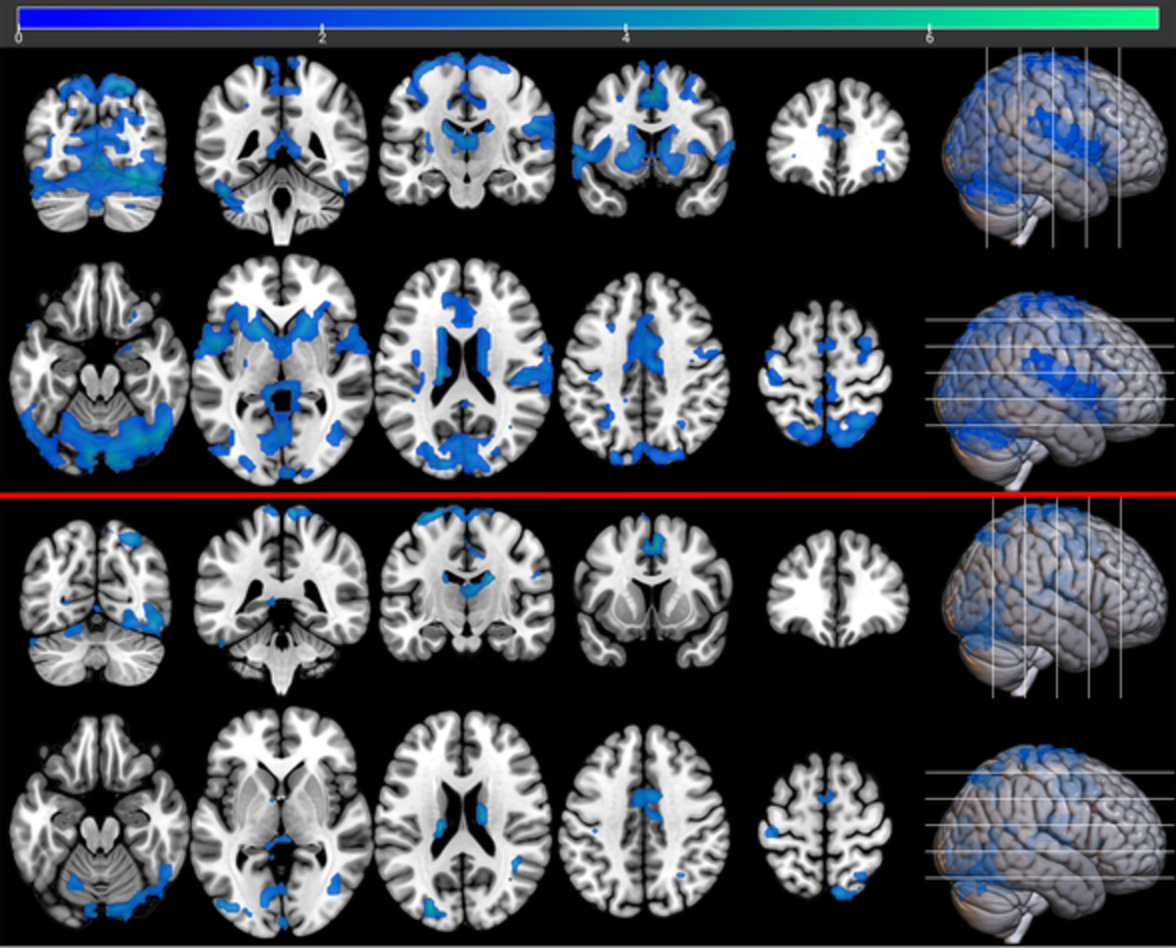 The effect of risperidone on reward-related brain activity is robust to drug-induced vascular changes