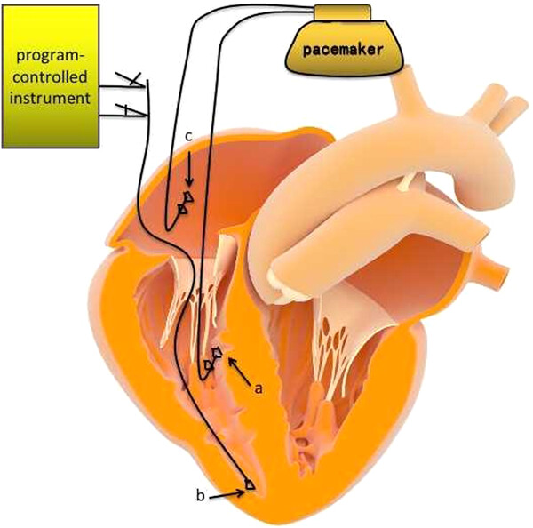 Comparison of the safety and efficiency of temporary cardiac pacing methods during left bundle branch pacemaker implantation: Femoral vein pacing versus atrial spiral pacing with electrodes placed at the ventricle