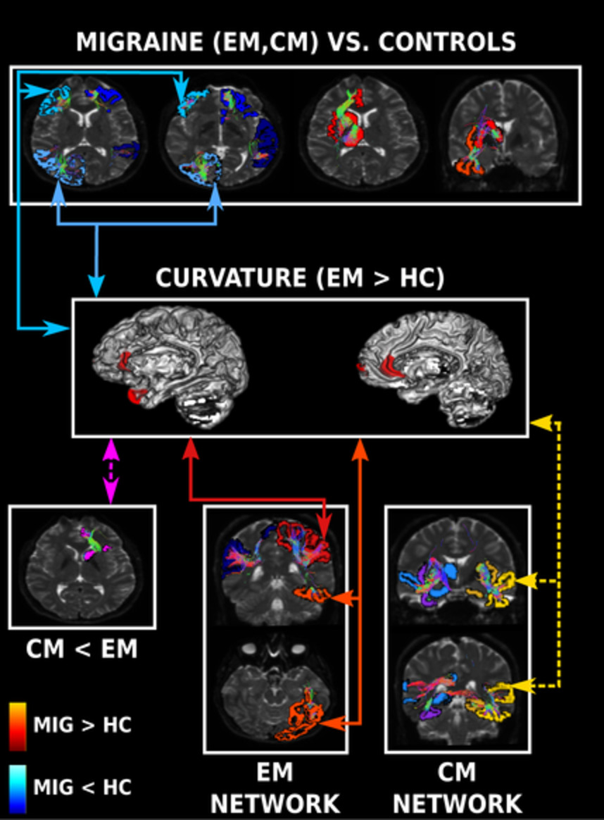 Multimodal fusion analysis of structural connectivity and gray matter morphology in migraine