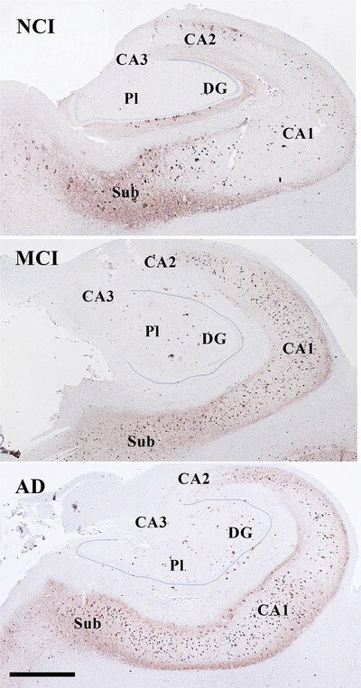 Oligomeric, phosphorylated, and truncated tau and spliceosome pathology within the entorhinal–hippocampal connectome across stages of Alzheimer's disease