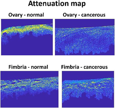 Depth-resolved attenuation mapping of the human ovary and fallopian tube using optical coherence tomography