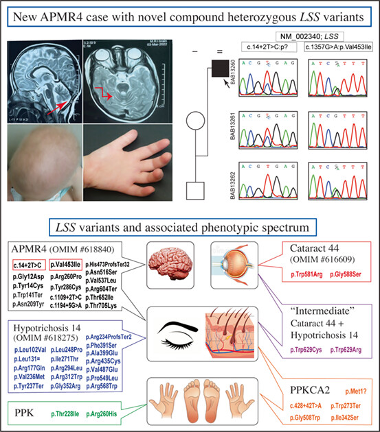 Novel LSS variants in alopecia and intellectual disability syndrome: New case report and clinical spectrum of LSS-related rare disease traits