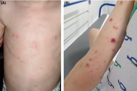 A child with mastocytosis and lymphomatoid papulosis