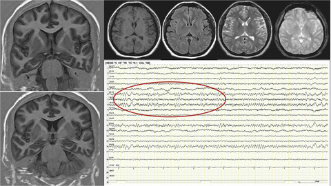 Cognitive decline among individuals with history of mild symptomatic SARS-CoV-2 infection: A longitudinal prospective study nested to a population cohort