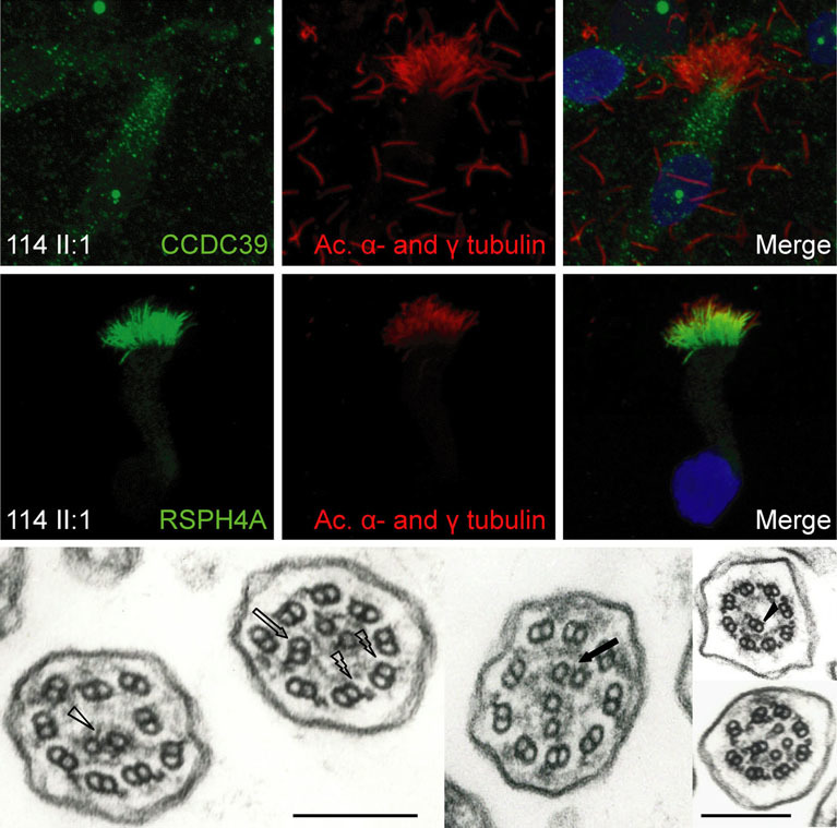 Mutations in CCDC39 and CCDC40 are the Major Cause of Primary Ciliary Dyskinesia with Axonemal Disorganization and Absent Inner Dynein Arms
