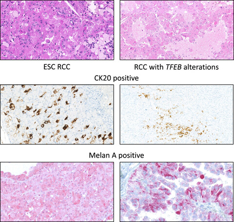 Eosinophilic solid and cystic renal cell carcinoma and renal cell carcinomas with TFEB alterations: a comparative study