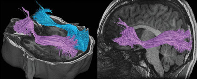 A window into eye movement dysfunction following mTBI: A scoping review of magnetic resonance imaging and eye tracking findings