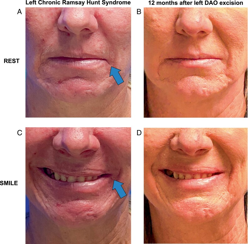 Changes in Perceived Emotions in Facial Paralysis Patients After Depressor Anguli Oris Excision