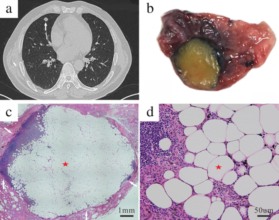 Lipolymph node presenting as a pulmonary nodule: A case report
