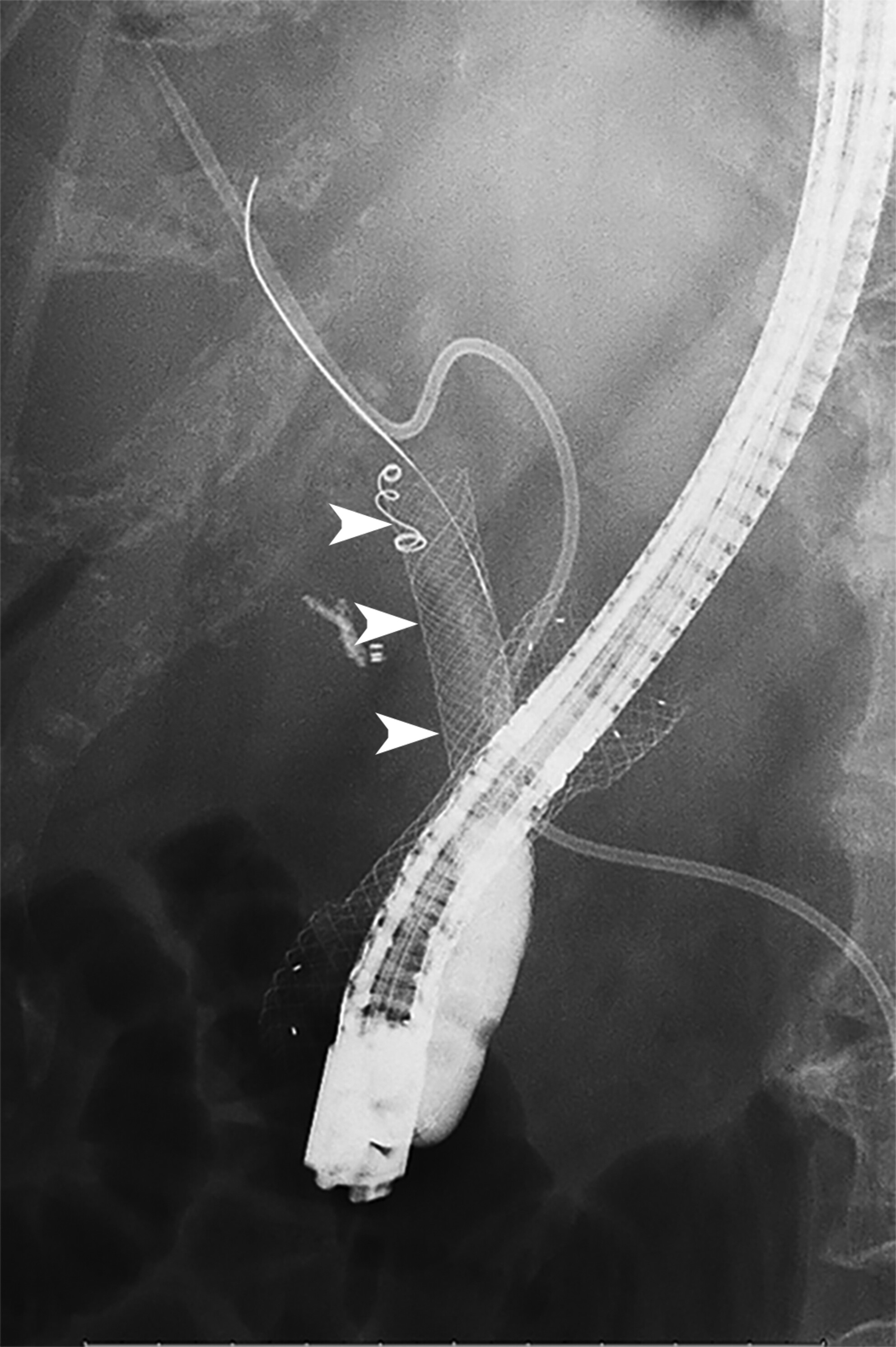 Two salvage techniques using a large dilation balloon: Endoscopic recovery of a migrated biliary metal stent and endoscope passage through a difficult duodenal stricture in combination with a duodenal stent