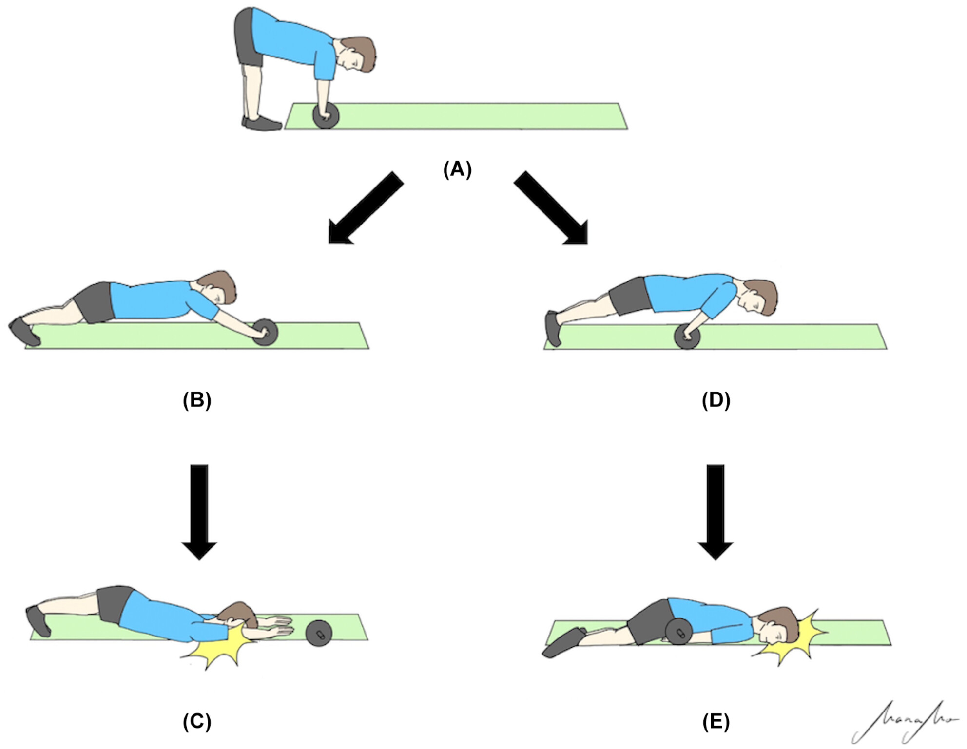 Spinal cord injury without radiological abnormality due to a fall while using an abdominal roller: A report of two cases