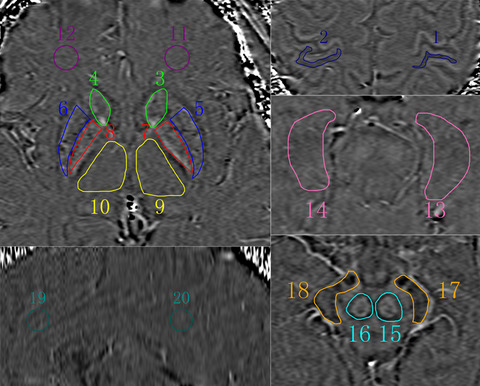 Brain iron deposition in primary insomnia—An in vivo susceptibility-weighted imaging study