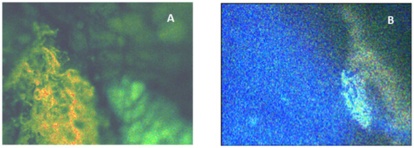 Real-time detection of breast cancer at the cellular level