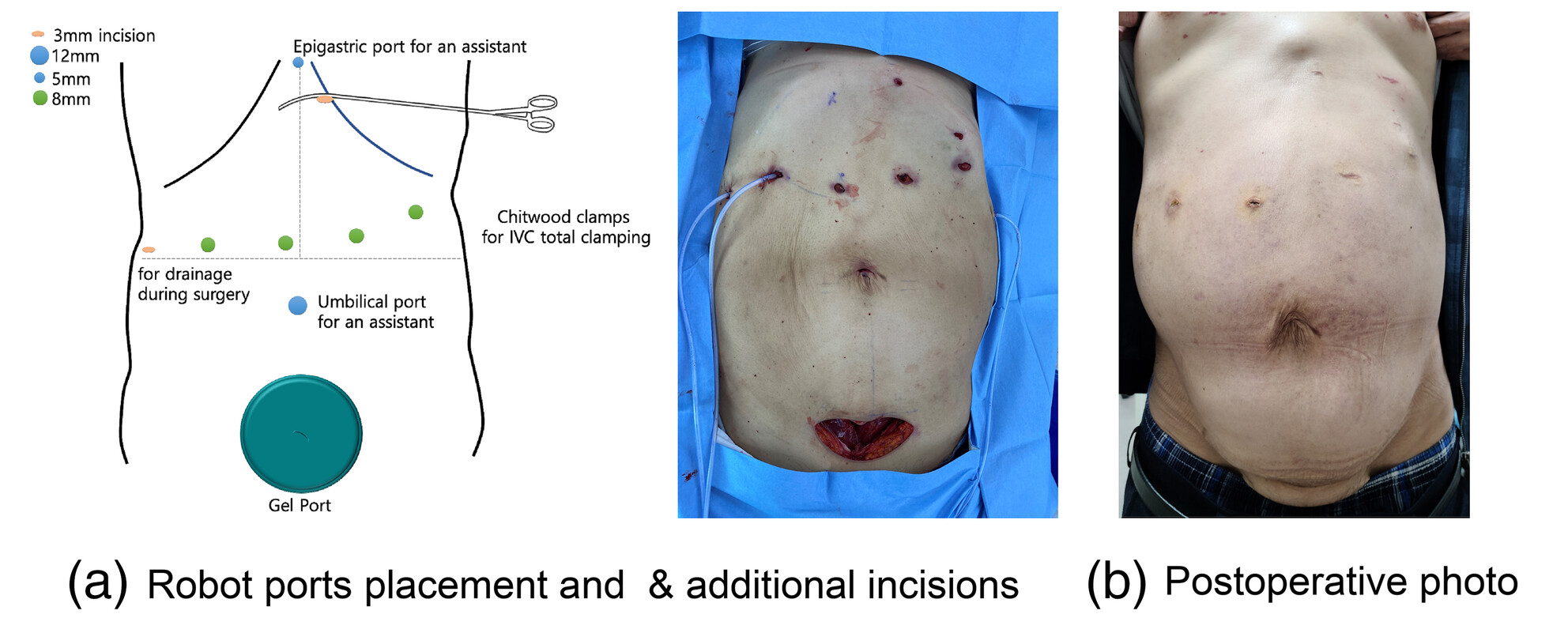 Total robot-assisted recipient's surgery in living donor liver transplantation: First step towards the future