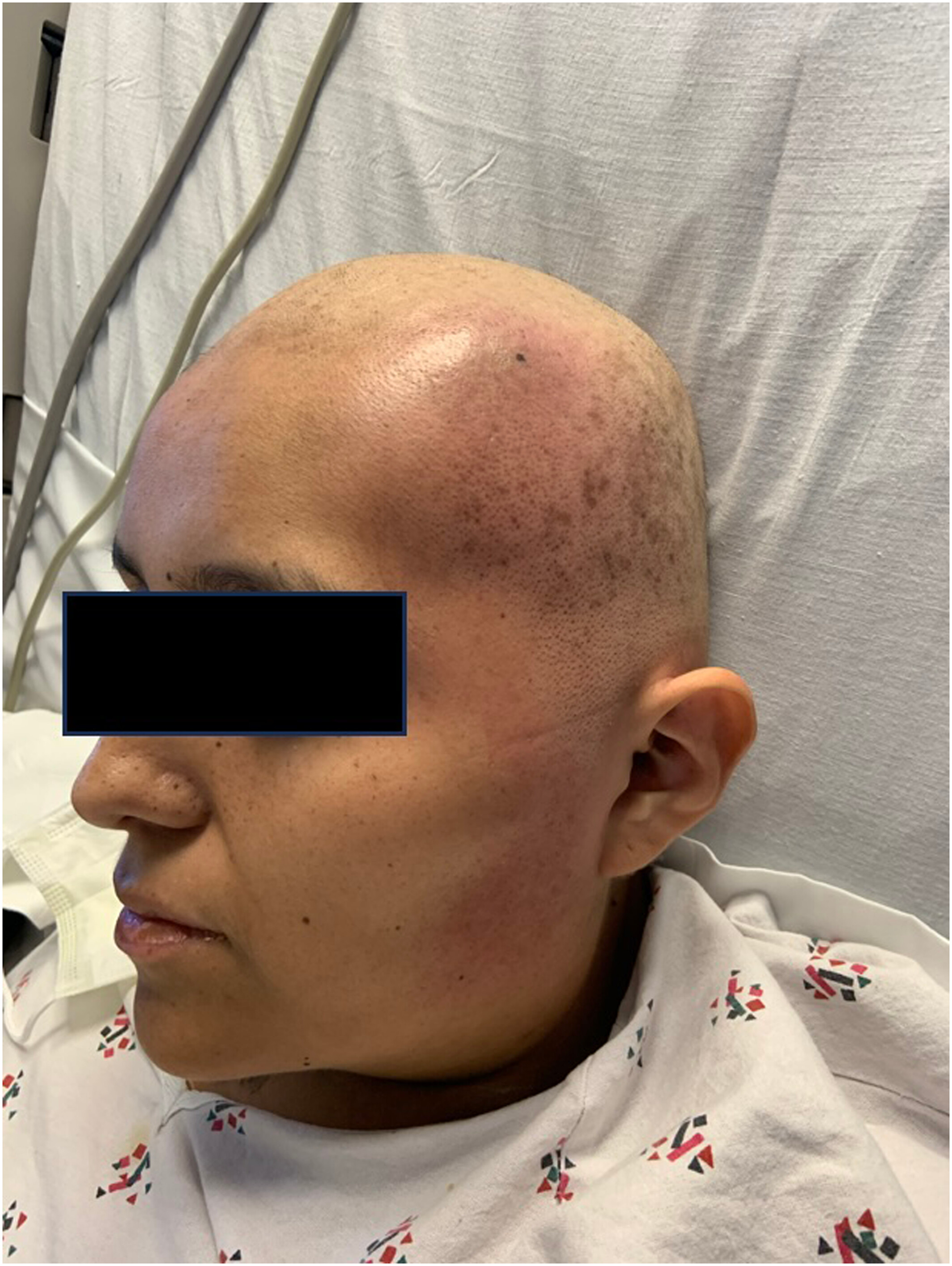 Expanding subcutaneous mass on the scalp of an immunocompromised woman