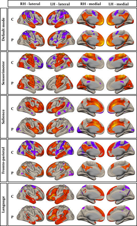 Resting-state functional brain networks in adults with a new diagnosis of focal epilepsy