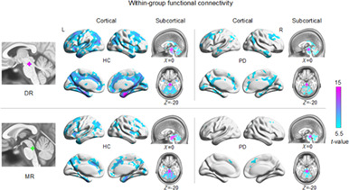 Common and unique dysconnectivity profiles of dorsal and median raphe in Parkinson's disease