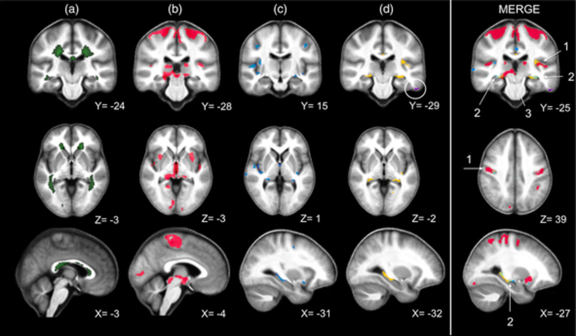 Voxel-Based quantitative MRI reveals spatial patterns of grey matter alteration in multiple sclerosis