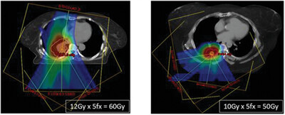 New technologies and machines for stereotactic radiation therapy