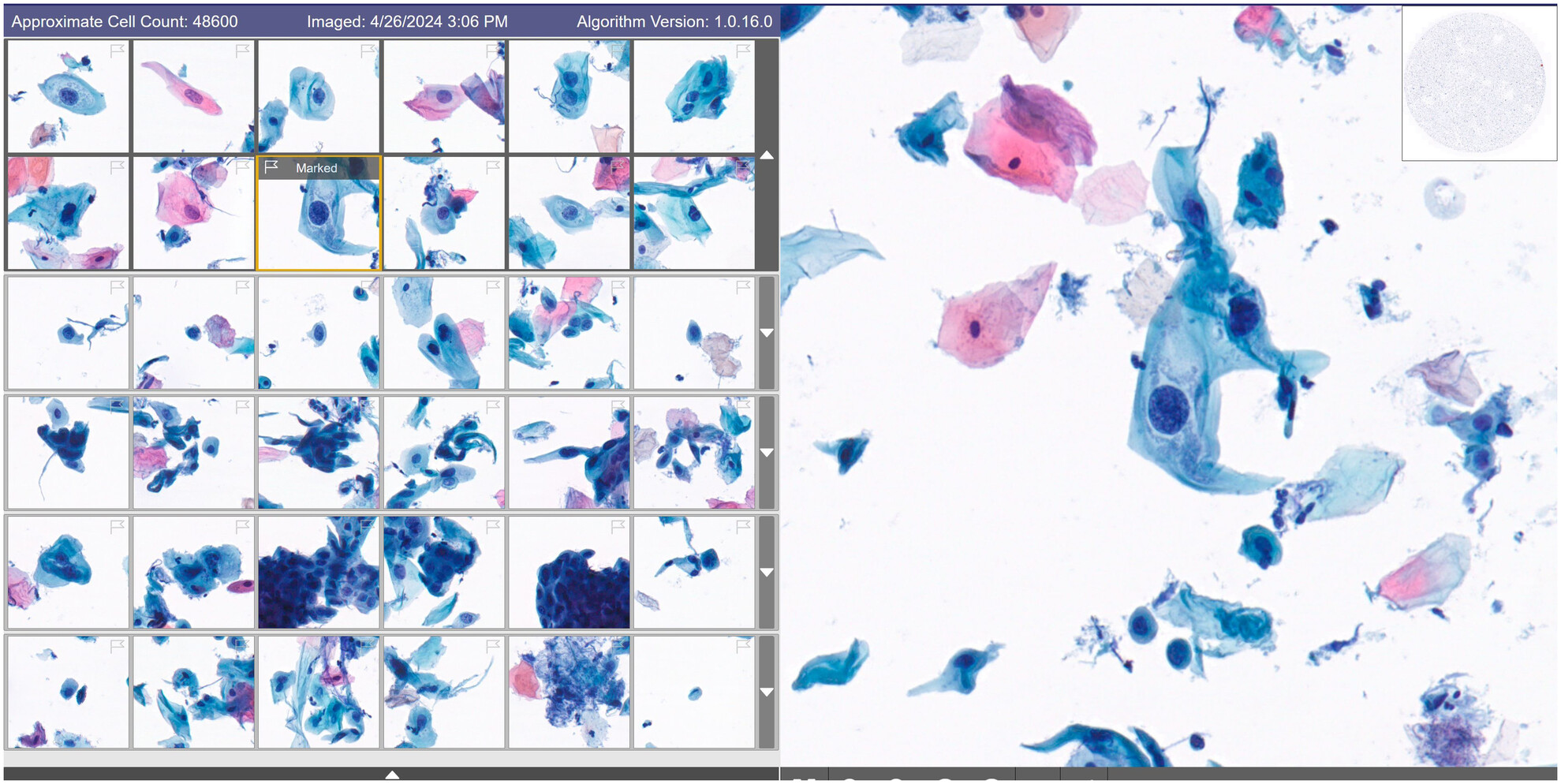 Digital Cytology Combined With Artificial Intelligence Compared to Conventional Microscopy for Anal Cytology: A Preliminary Study