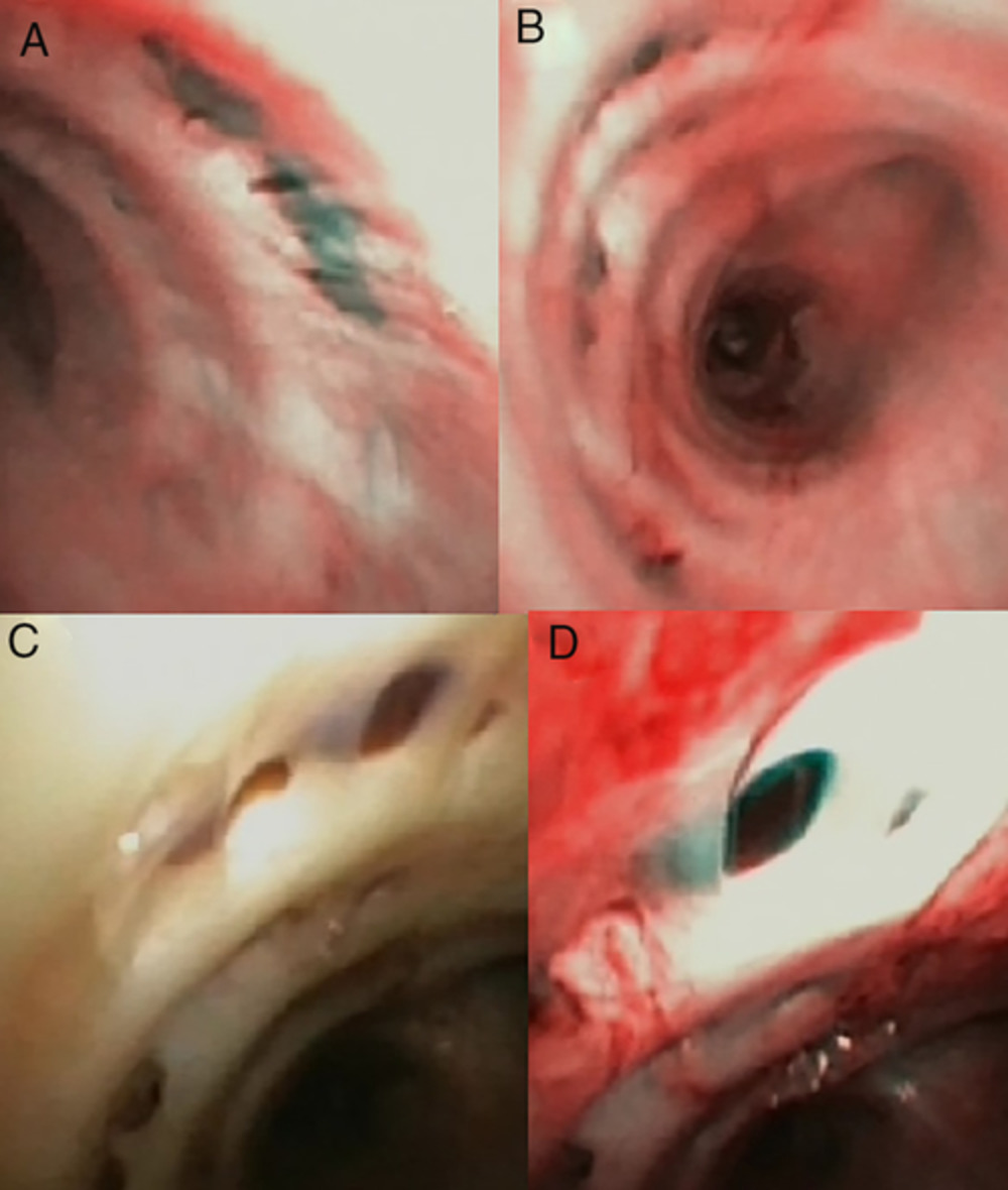 Endobronchial vasculitis in childhood granulomatosis with polyangiitis