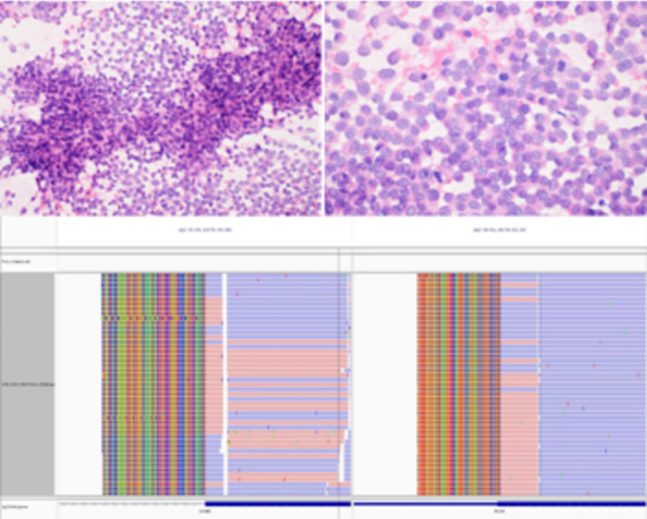 Unveiling Diagnostic Clues of BCOR-CCNB3 Sarcoma in Fine-Needle Aspiration Specimens