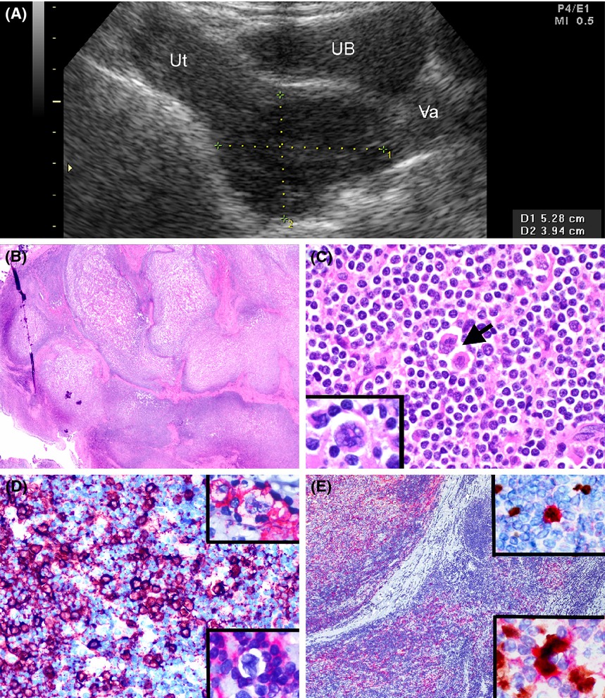 Primary nodular lymphocyte-predominant Hodgkin lymphoma of uterine cervix mimicking leiomyoma