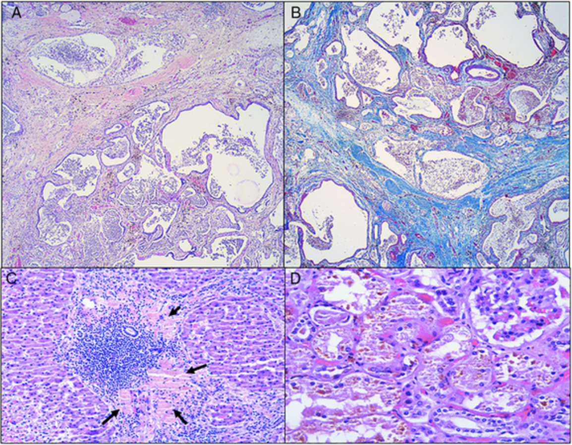 A family history of Hermansky–Pudlak syndrome complicated with pulmonary fibrosis: a case series and review