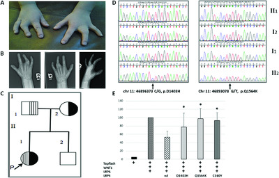 Mutations in the fourth β-propeller domain of LRP4 are associated with isolated syndactyly with fusion of the third and fourth fingers