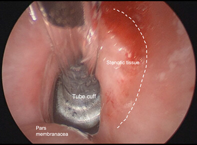 Post-Covid-19 Airway Stenosis: Tracheal Resection-Anastomosis Using The Tritube® Ventilation