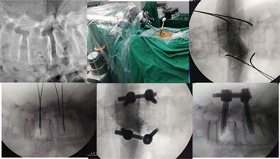 Robot-Assisted Minimally Invasive Transforaminal Lumbar Interbody Fusion in the Treatment of Lumbar Spondylolisthesis