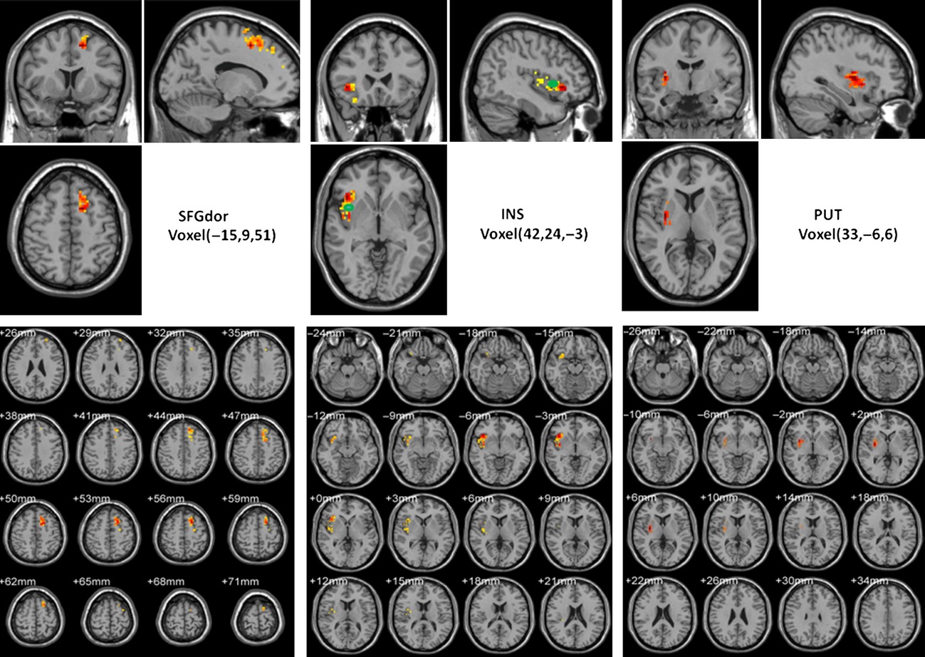 A reversal coarse-grained analysis with application to an altered functional circuit in depression
