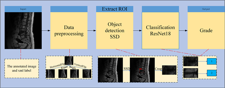 Automatic Detection and Classification of Modic Changes in MRI Images Using Deep Learning: Intelligent Assisted Diagnosis System