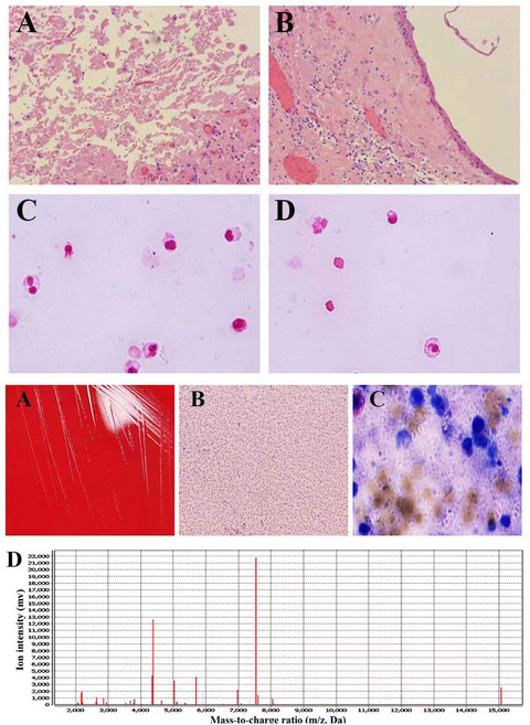 Identification of sacrococcygeal and pelvic abscesses infected with invasive Mycoplasma hominis by MALDI-TOF MS