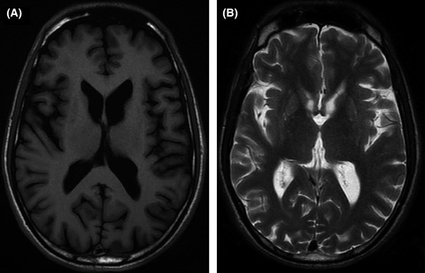 Examination of Huntington's disease with atypical clinical features in a Bangladeshi family tree