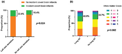 Electrocardiogram properties and risk of covert brain infarction and other magnetic resonance imaging abnormalities in a stroke-free population