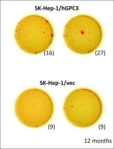 Suppression of postsurgical recurrence of hepatocellular carcinoma treated with autologous formalin-fixed tumor vaccine, with special reference to glypican-3