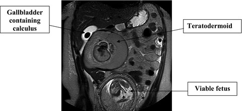 Teratodermoid mimicking cholecystitis