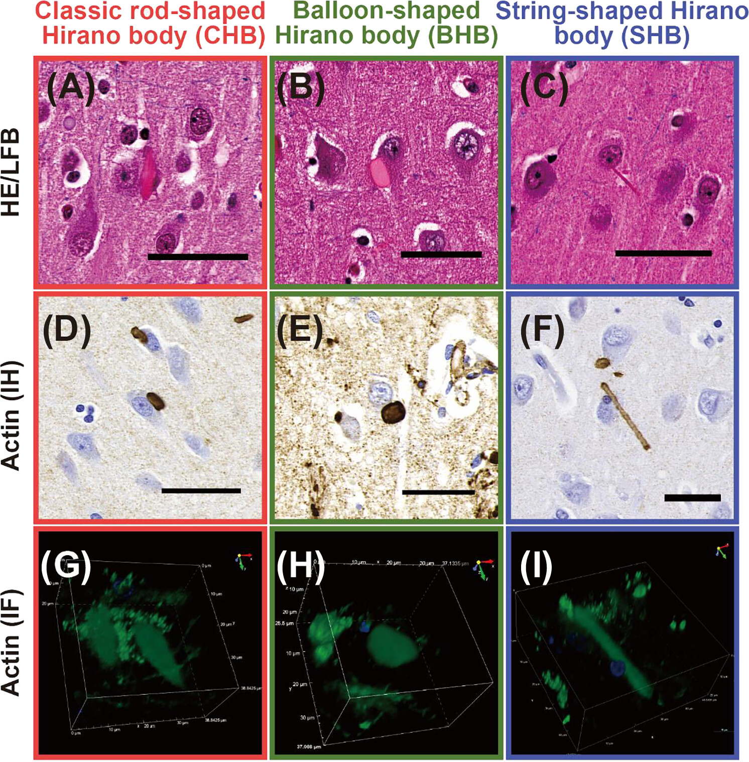Revisiting the relevance of Hirano bodies in neurodegenerative diseases