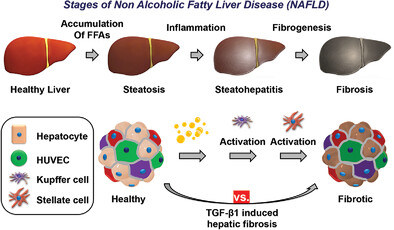 Bioengineered Multicellular Liver Microtissues for Modeling Advanced Hepatic Fibrosis Driven Through Non-Alcoholic Fatty Liver Disease
