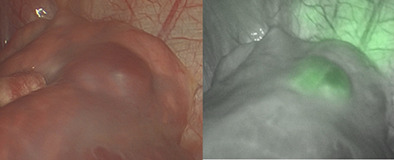 Indocyanine green navigation in minimally invasive resection of multiple metachronous pulmonary metastases of hepatoblastoma