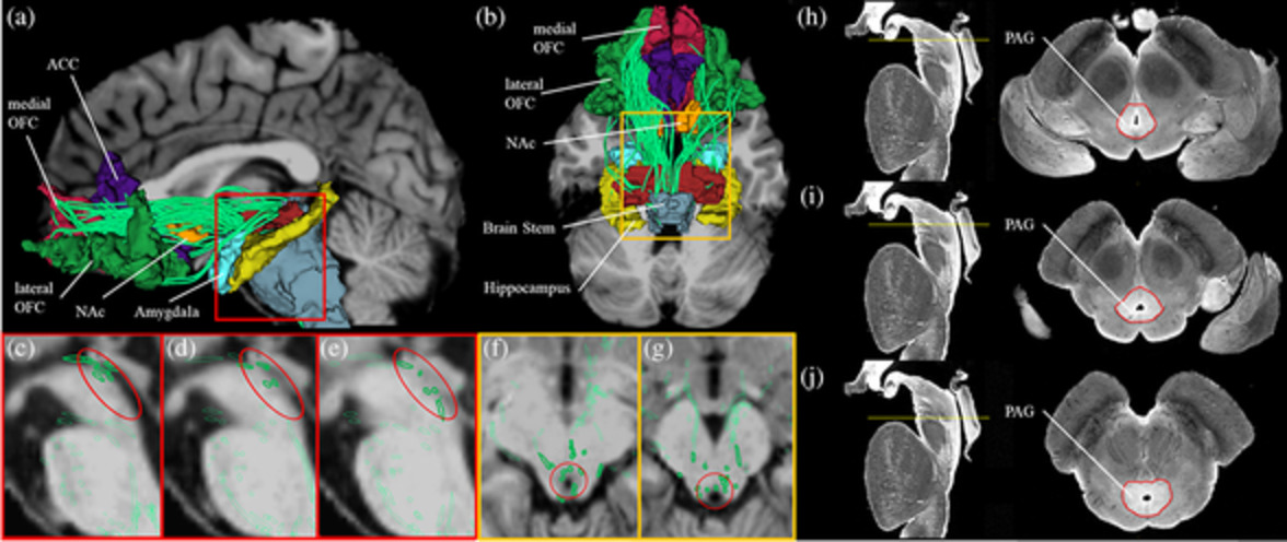 Microstructural alterations in medial forebrain bundle are associated with interindividual pain sensitivity