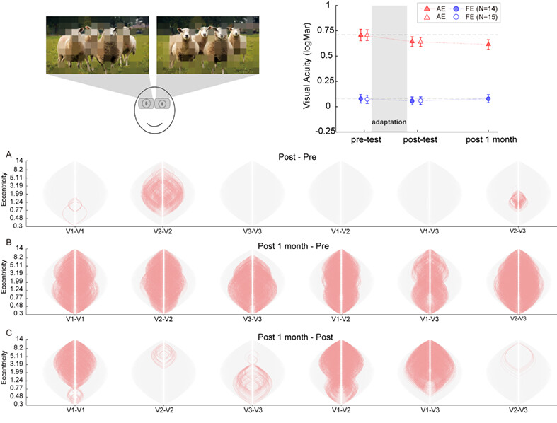 Treating amblyopia using altered reality enhances the fine-scale functional correlations in early visual areas