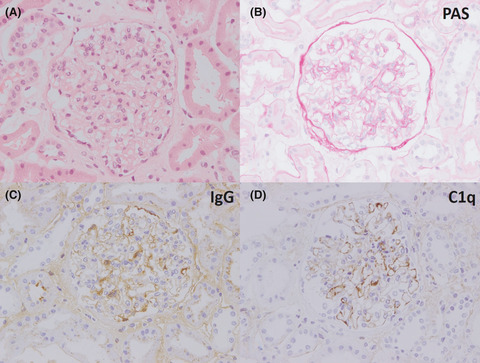 Successful treatment of HIV-associated lupus-like glomerulonephritis with mycophenolic acid