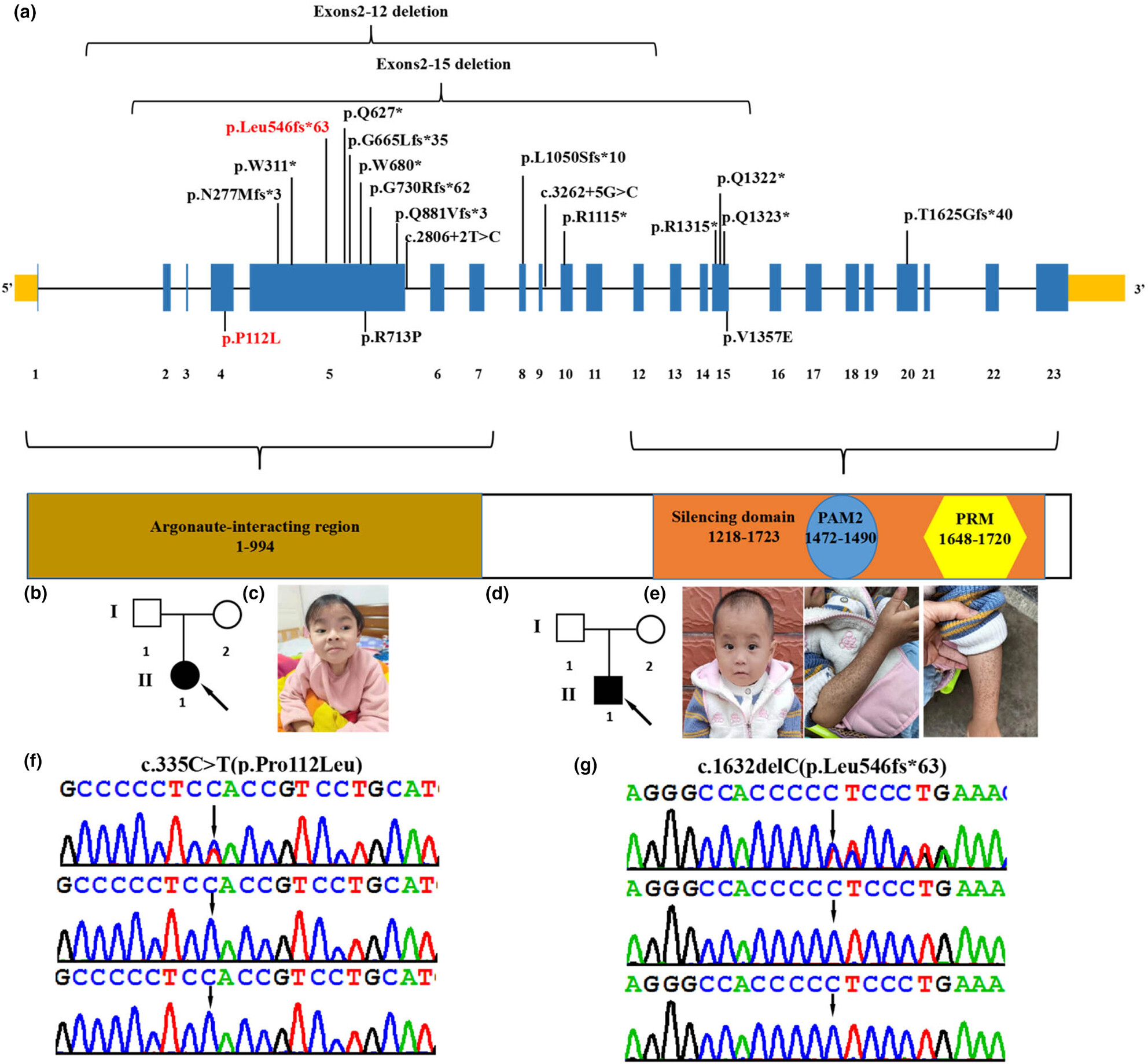 Novel variants in TNRC6B cause global developmental delay with speech and behavioral abnormalities, short stature, low body weight, café-au-lait spots, and metabolic abnormality