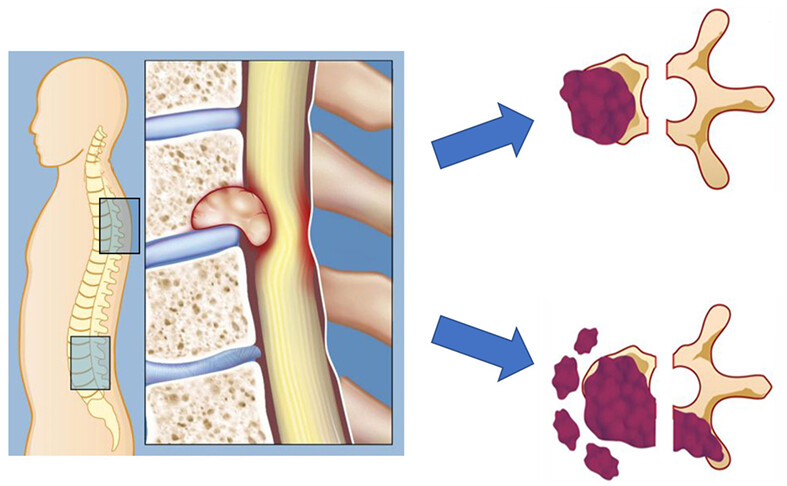 Surgical Strategy for Recurrent Giant Cell Tumor in the Thoracolumbar Spine