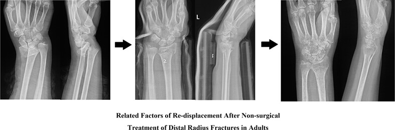 Factors Associated with Re-Displacement after Nonsurgical Treatment of Distal Radius Fractures in Adults: A Retrospective Study