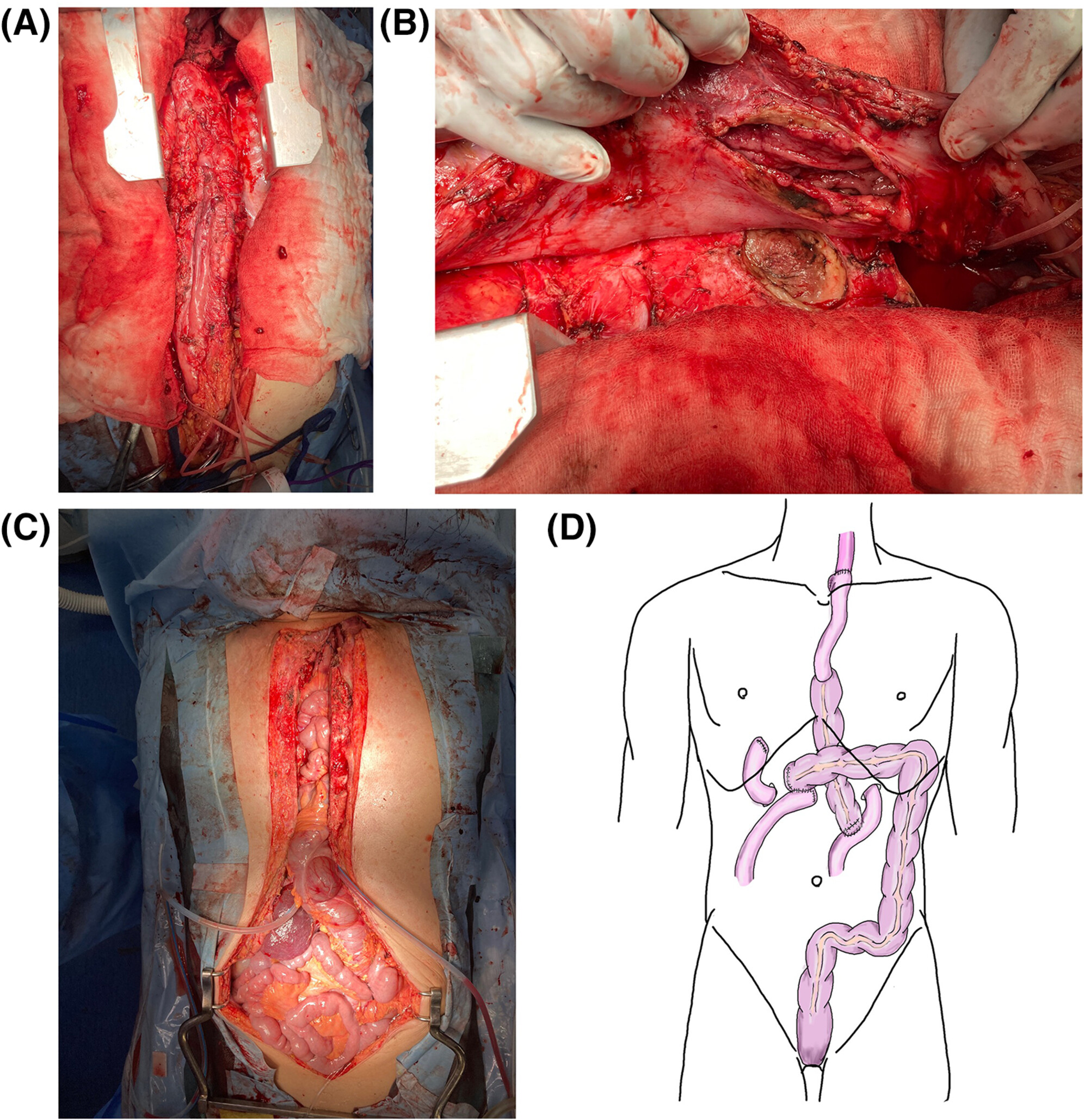 Gastric tube perforation penetrating the pericardium after esophagectomy that needed surgical repair
