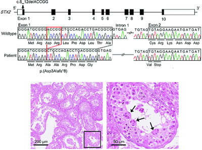 STX2 is a causative gene for nonobstructive azoospermia