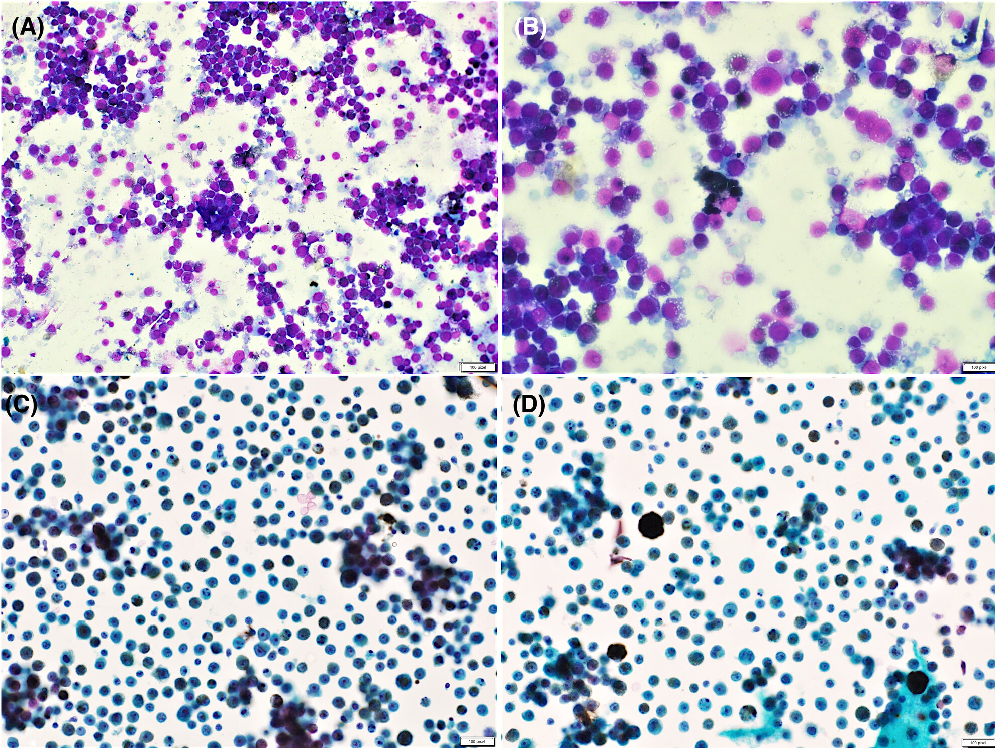 Bugs' eyes and black monsters: Ascitic fluid cytology in an elderly male with hematochezia